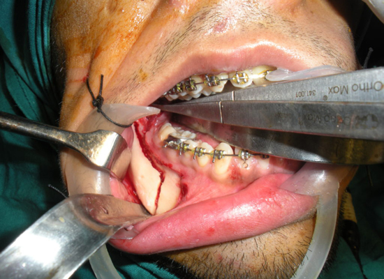 ORAL-MAXILLOFACIAL-SURGERY