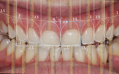 digital-smile-design